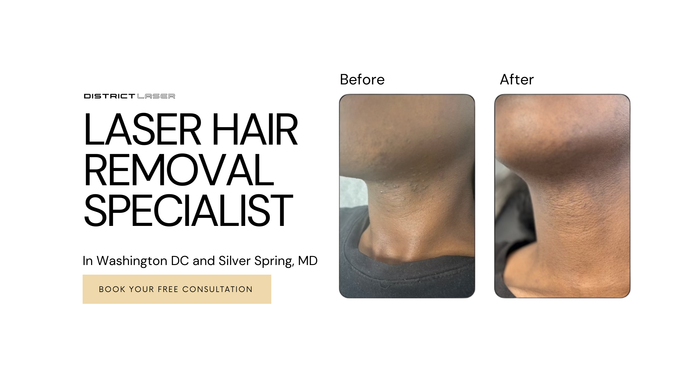 Laser Hair Removal Services in Silver Spring, MD  districtlaser