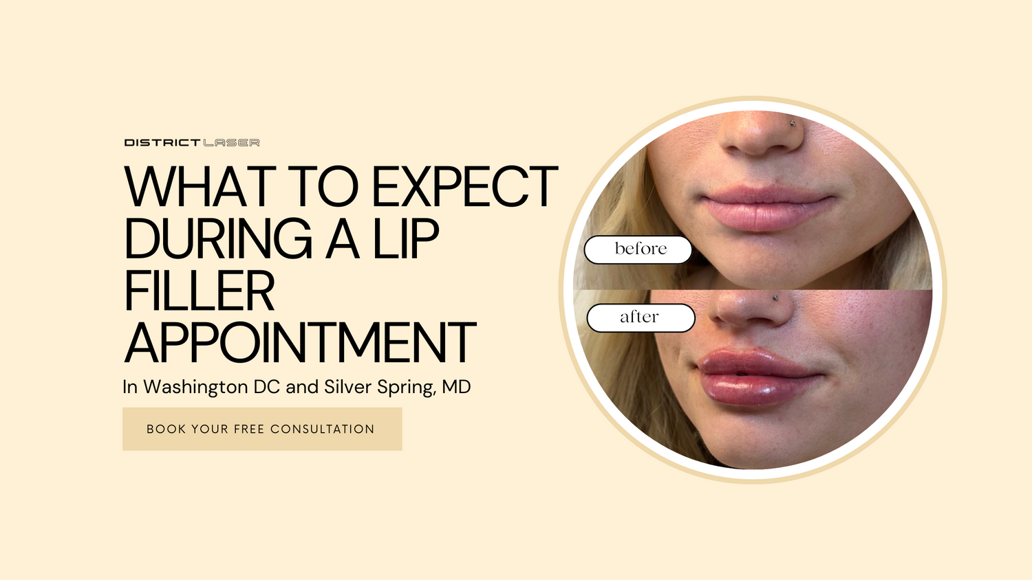 Lip Fillers in Washington DC