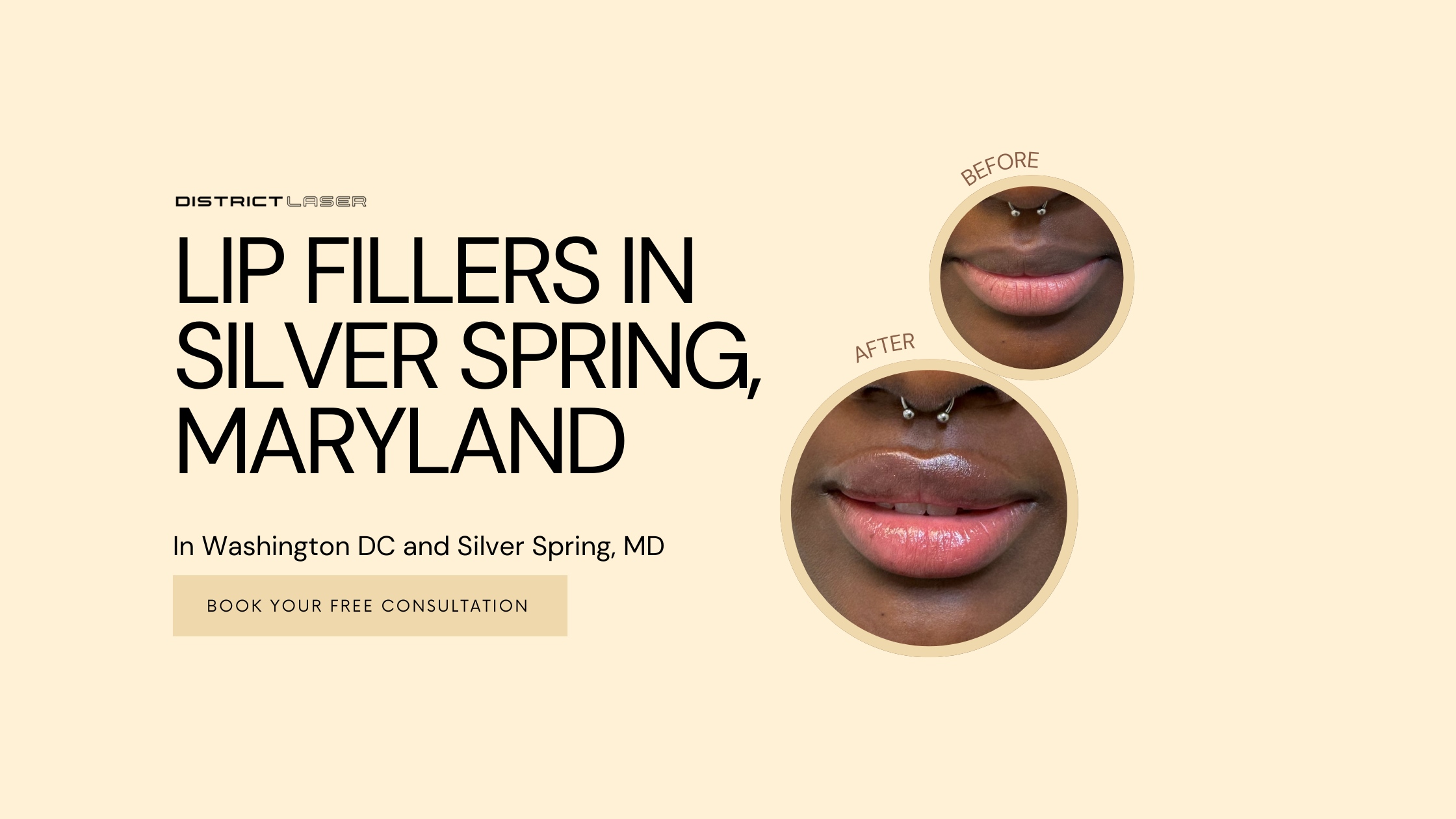 Lip Fillers in Silver Spring Maryland