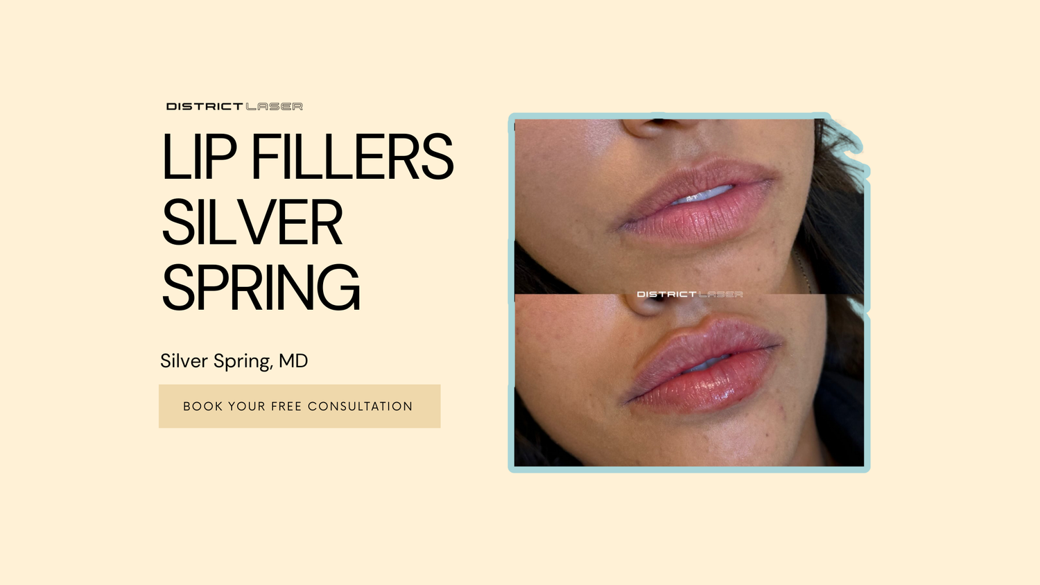 lip filler silver spring md