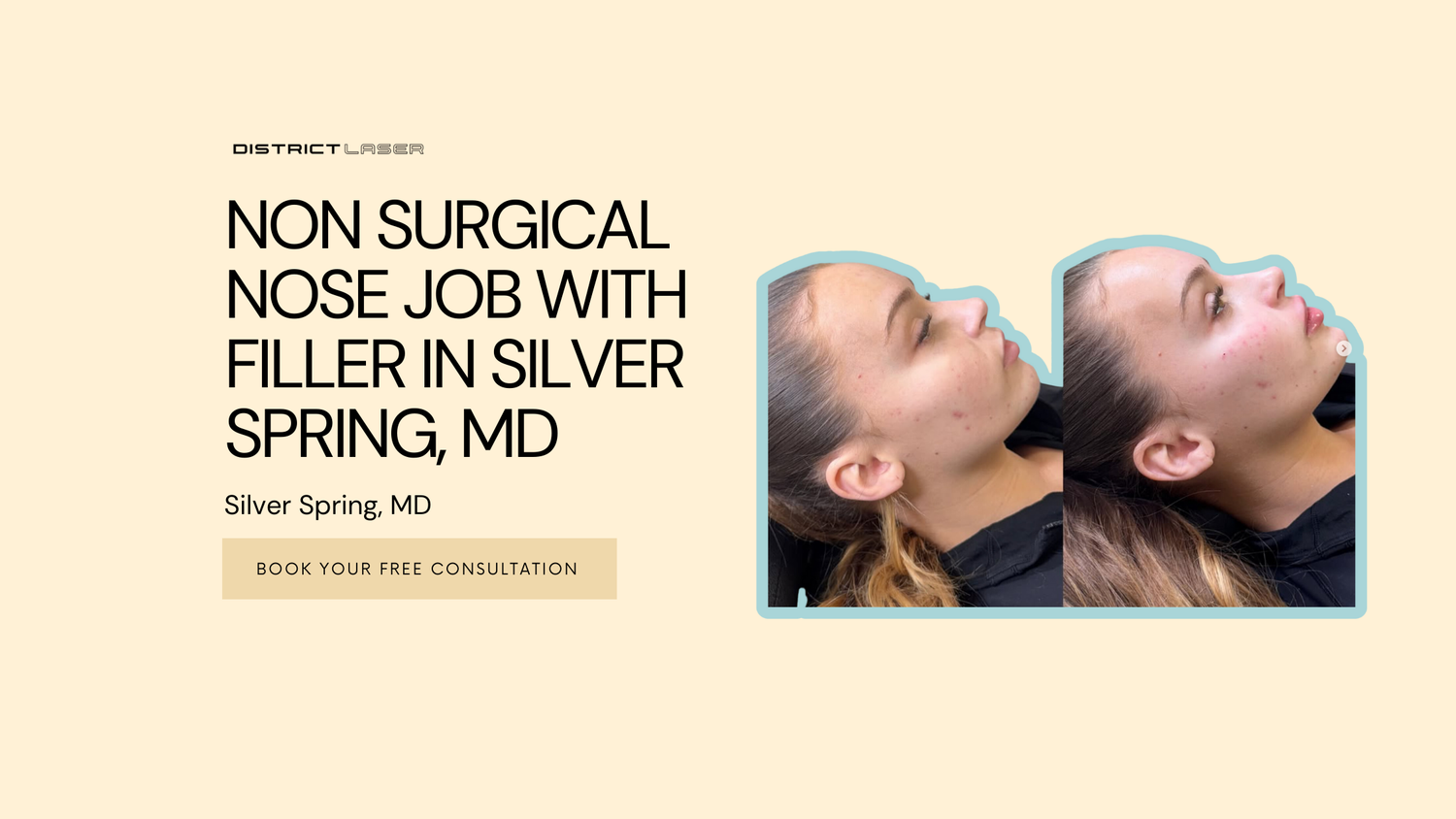 liquid rhinoplasty silver spring